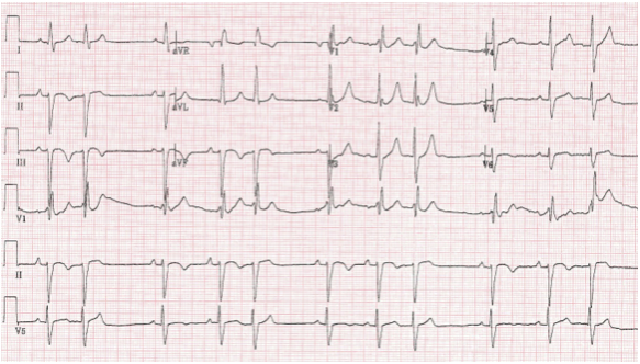 12 Lead ECG Practice #220115 - Conduction Defects - BrainyNurses.com